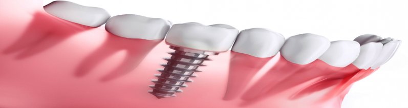 Single tooth Implant